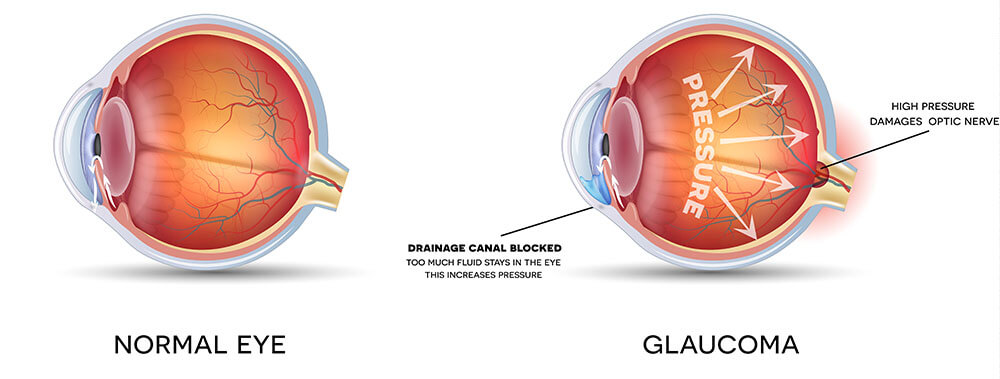 Normal Eye Compared To An Eye With Glaucoma