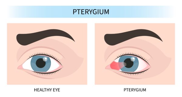 Pterygium Excision | Philadelphia Eye Associates